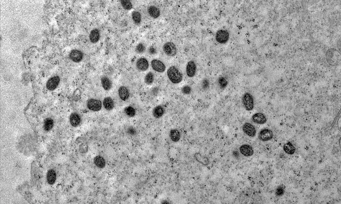 Conheca sintomas Mpox Balcao News 25 8 24 Debora F. barreto Vieira IOC Fiocruz